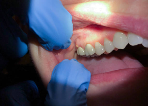 Best Emergency Care for Gum Disease in Ashland, MO
